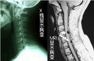 頸椎管狹窄症