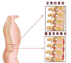 脊椎炎