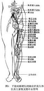 下肢動脈硬化閉塞症