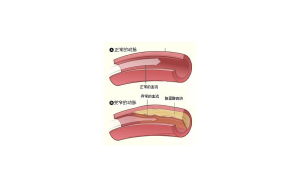 主動脈硬化