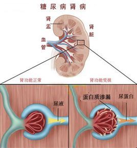 糖尿病併發症 腎病