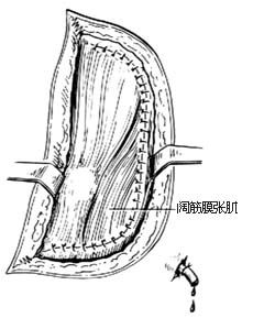 髖關節結核