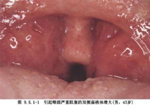 慢性扁桃體炎手術