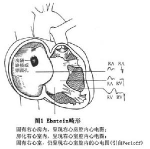 埃布斯坦綜合徵