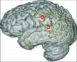 一位癲癇症患者大腦的核磁共振成像圖，圖片顯示兩種電極的位置分布情況。一種電極是傳統的腦皮層電圖電極(黃色)，用於定位癲癇發作的源頭，從而幫助醫生進行手術。紅色的則是兩組實驗用微腦皮層電圖電極，每組陣列包括16個微電極，用於讀取來自大腦的語言信號。