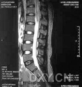 急性壞死出血性腦脊髓炎