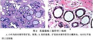 乳腺腺病 圖2