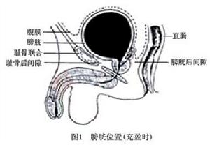 膀胱上內疝