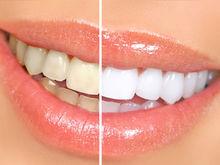 治療前後的牙齒對比