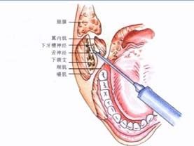 上牙槽後神經阻滯麻醉