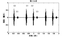 圖10 帶有第三心音