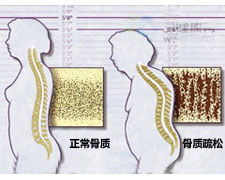 骨質疏鬆綜合症