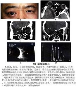 鼻部腦膜腦膨出