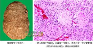 局灶性腎炎