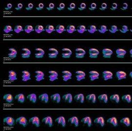 心肌灌注顯像