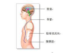 圖2腦室-腹腔分流法原理