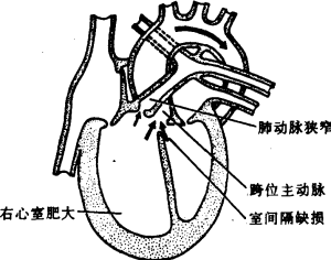 法樂氏四聯症