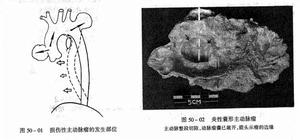 缺血半影區