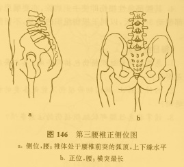 第三腰椎橫突綜合症