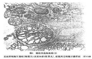 眼瞼基底細胞癌