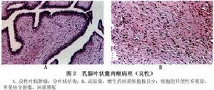 乳腺葉狀囊肉瘤