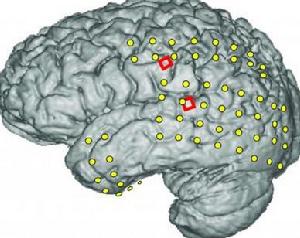 一位癲癇症患者大腦的核磁共振成像圖，圖片顯示兩種電極的位置分布情況。一種電極是傳統的腦皮層電圖電極(黃色)，用於定位癲癇發作的源頭，從而幫助醫生進行手術。紅色的則是兩組實驗用微腦皮層電圖電極，每組陣列包括16個微電極，用於讀取來自大腦的語言信號。