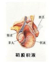 交通性鞘膜積液