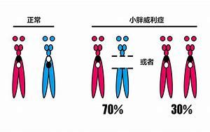 小胖威利綜合徵