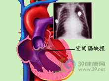 先天性主動脈瓣竇動脈瘤破裂