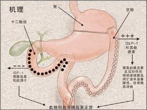 胃轉流手術優勢