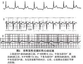 陣發性心動過速