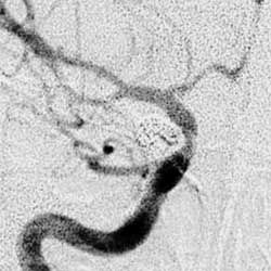 （圖）腦內動脈瘤