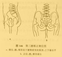 L3橫突綜合症