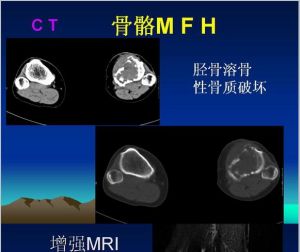 惡性纖維組織細胞瘤影像學