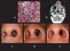 鼻部腫瘤