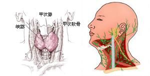 橋本式甲狀腺炎