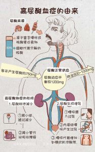 高尿酸血症