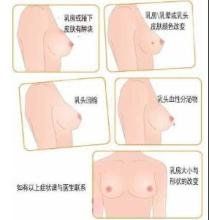 炎性乳腺癌