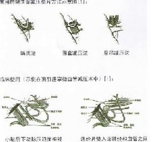 微血管減壓術