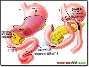 胰腺損傷