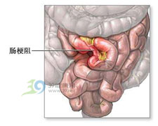 機械性腸梗阻