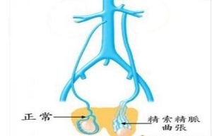 精索靜脈