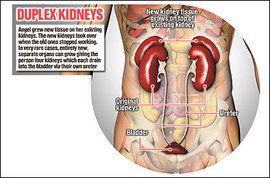 重複腎