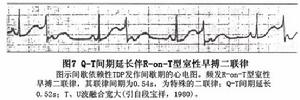 間歇依賴型尖端扭轉型室性心動過速