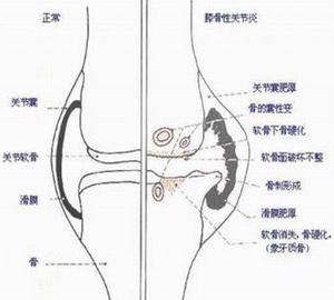 慢性滑膜炎是膝關節