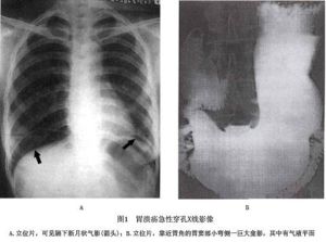 胃潰瘍性穿孔