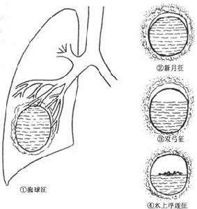 肺包蟲囊腫