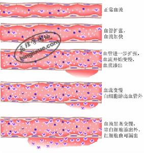 急性炎症