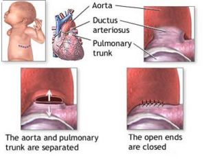 先天性動脈導管未閉