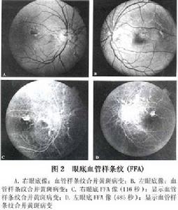 眼底血管樣條紋